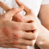 Dragulj: alergen proizvod ili ne