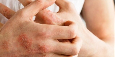 Dragulj: alergen proizvod ili ne